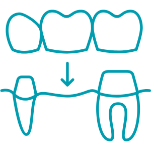 Full Arch Implants