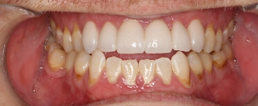 porcelain-crowns-after