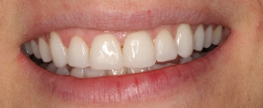 veneers-slide-2-after