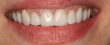 veneers-slide-3-after