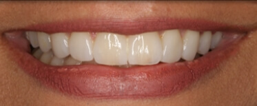 veneers-slide-4-after