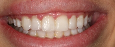 veneers-slide-5-after