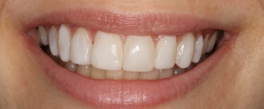 veneers-slide-6-after (1)