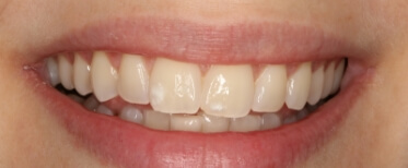 veneers-slide-6-before